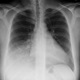 PNEUMONIA Single