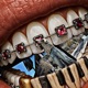 BRACES Single