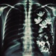 F k Cancer Single