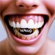 Veneers Single