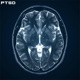 Ptsd Single